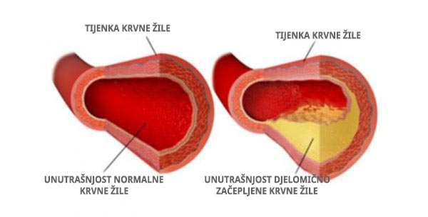 kolesterol in krvne žile