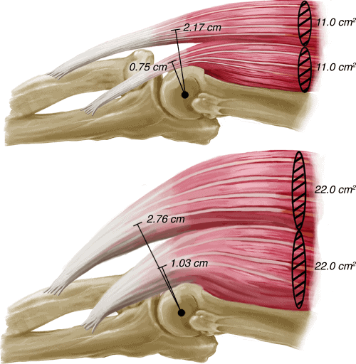 hipertrofija