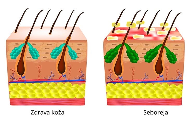 zdrava koža - seboreja