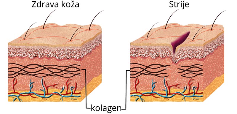 Strije-kolagen